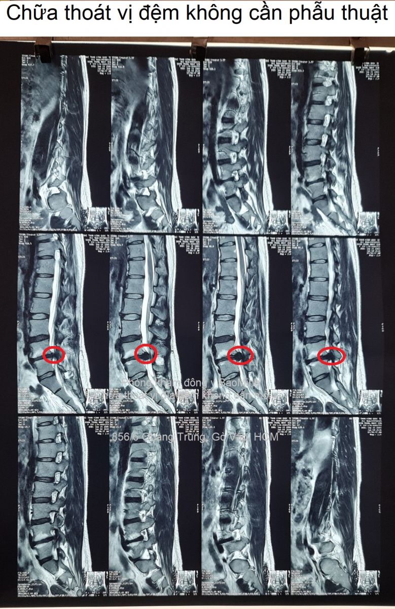 Chữa thoát vị đĩa đệm không cần phẫu thuật